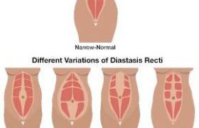 Diastaza-pri-Reha-MedicAL