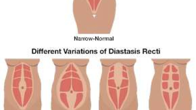Diastaza-pri-Reha-MedicAL