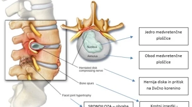 bolečine v nogah zaradi hrbtenice