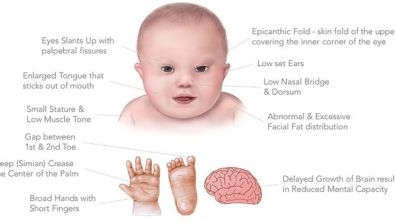 Downov sindrom znaki