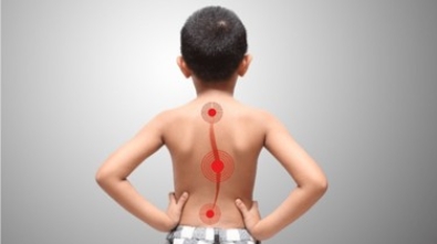 SKOLIOZA PRI OTROKU - Zakaj nastane?